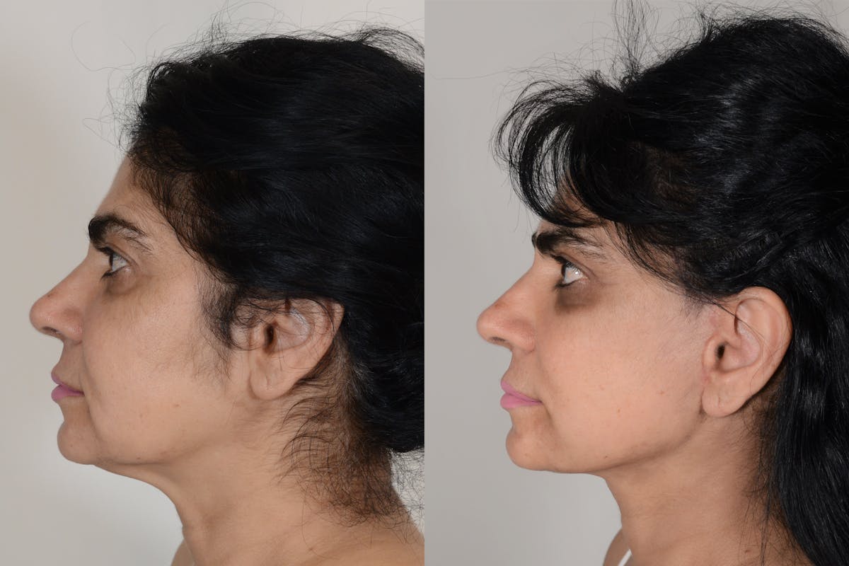 Facelift Before & After Gallery - Patient 206875 - Image 5