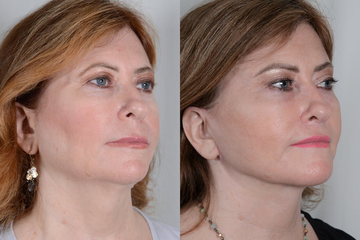 Facelift Before & After Gallery - Patient 214722 - Image 2