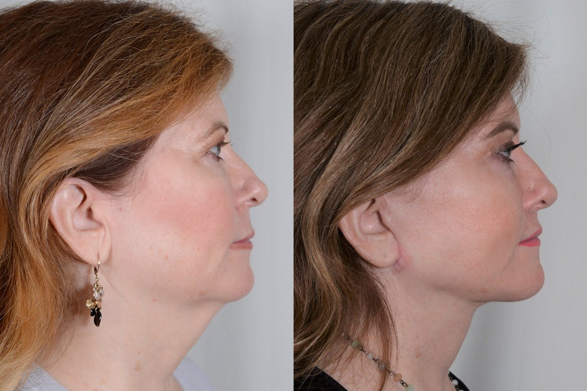 Facelift Before & After Gallery - Patient 214722 - Image 3