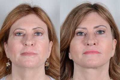 Facelift Before & After Gallery - Patient 214722 - Image 1