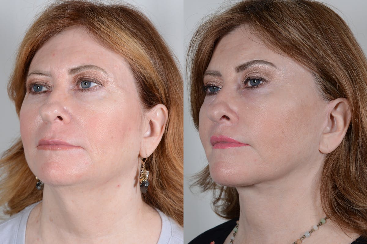 Facelift Before & After Gallery - Patient 214722 - Image 4