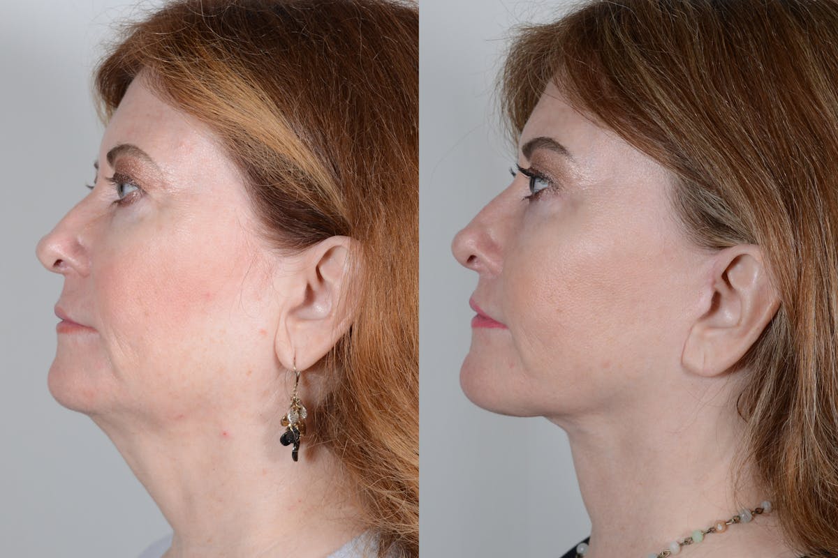 Facelift Before & After Gallery - Patient 214722 - Image 5