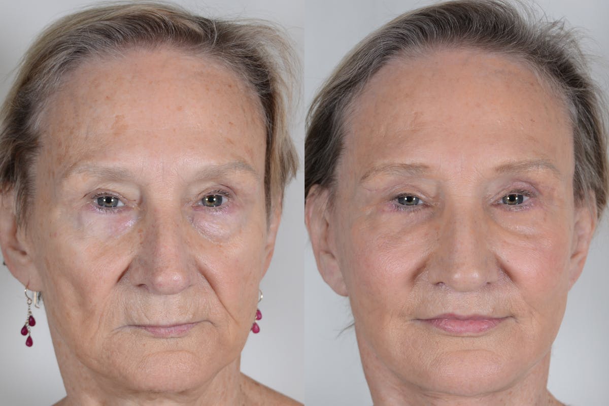 Facelift Before & After Gallery - Patient 985461 - Image 1