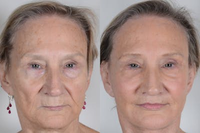 Facelift Before & After Gallery - Patient 985461 - Image 1