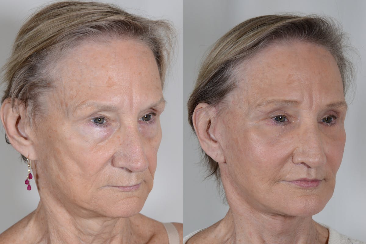 Facelift Before & After Gallery - Patient 985461 - Image 2
