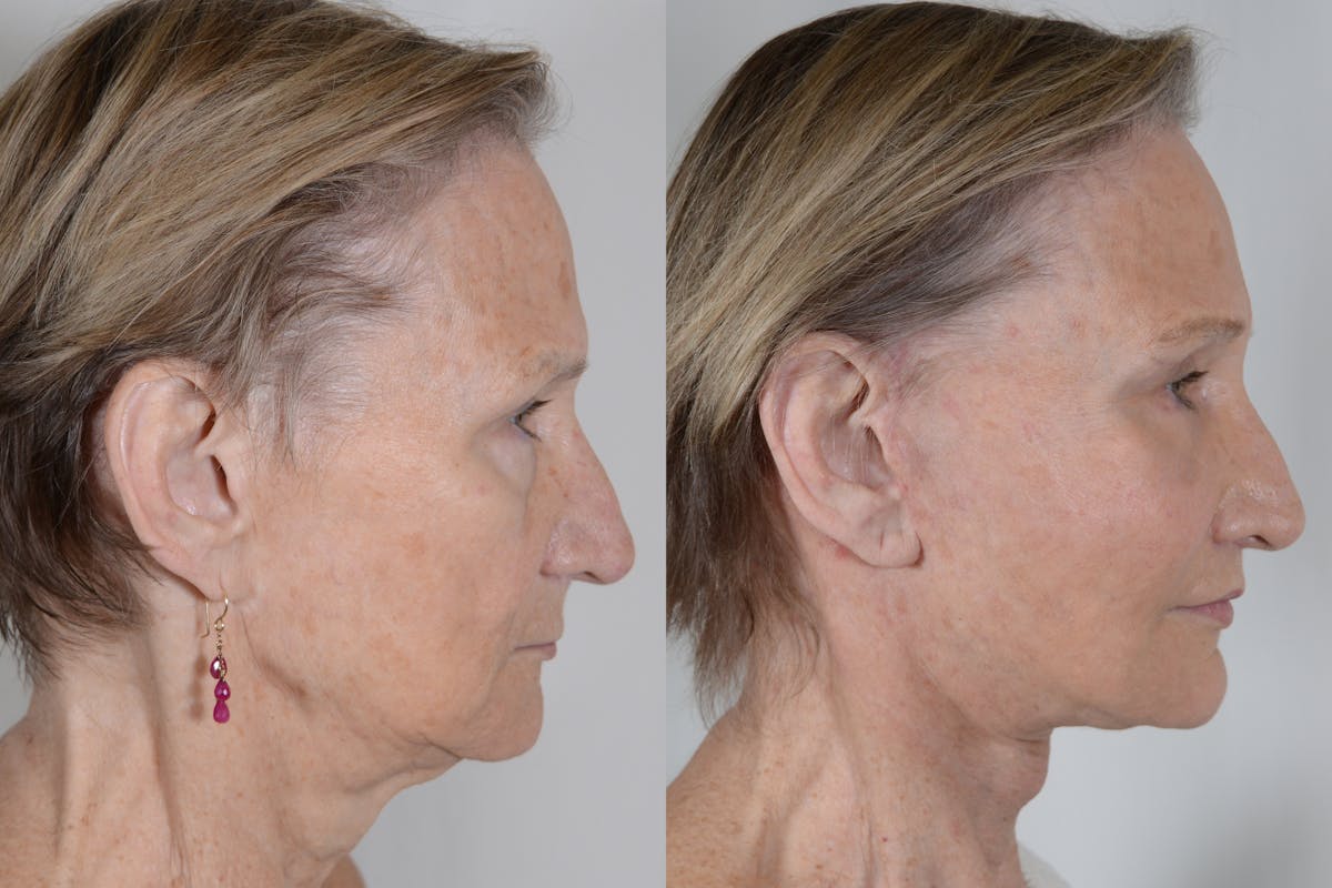 Facelift Before & After Gallery - Patient 985461 - Image 3