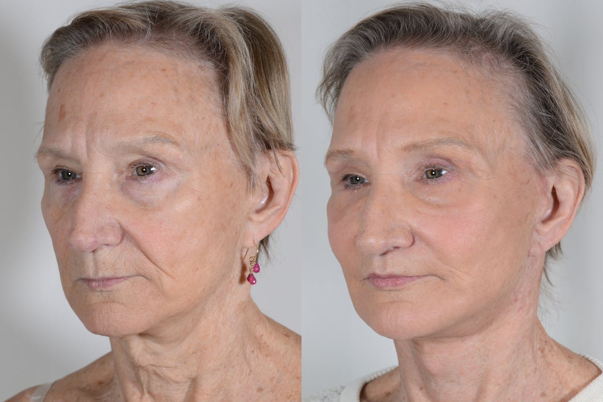 Facelift Before & After Gallery - Patient 985461 - Image 4