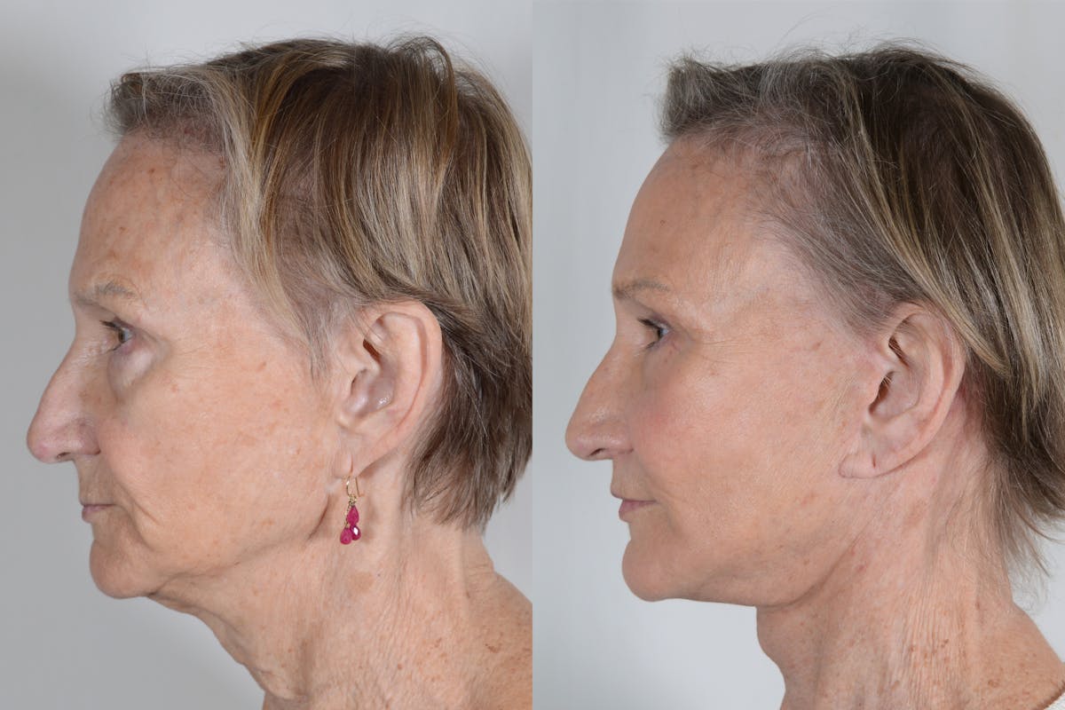 Facelift Before & After Gallery - Patient 985461 - Image 5