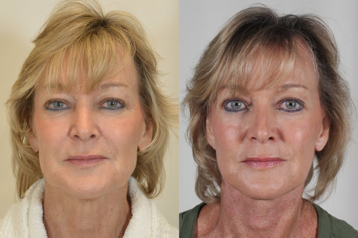 Facelift Before & After Gallery - Patient 115940 - Image 1