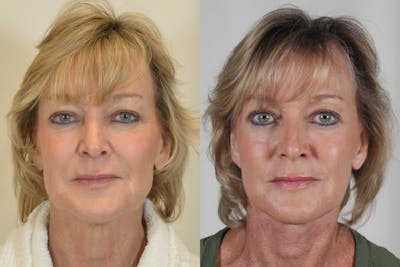 Facelift Before & After Gallery - Patient 115940 - Image 1