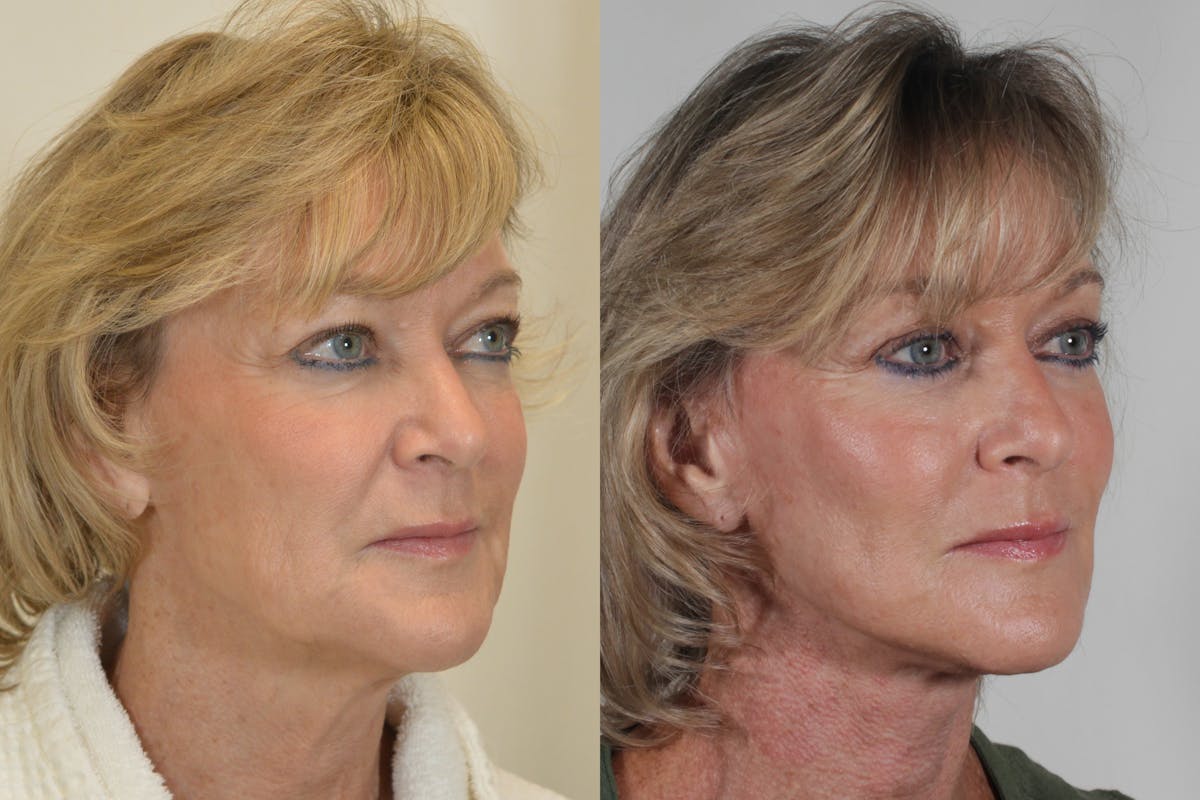 Facelift Before & After Gallery - Patient 115940 - Image 2