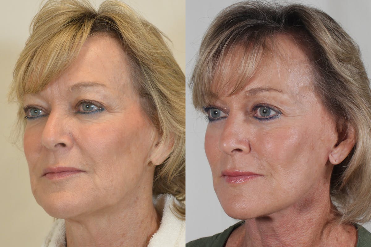 Facelift Before & After Gallery - Patient 115940 - Image 4