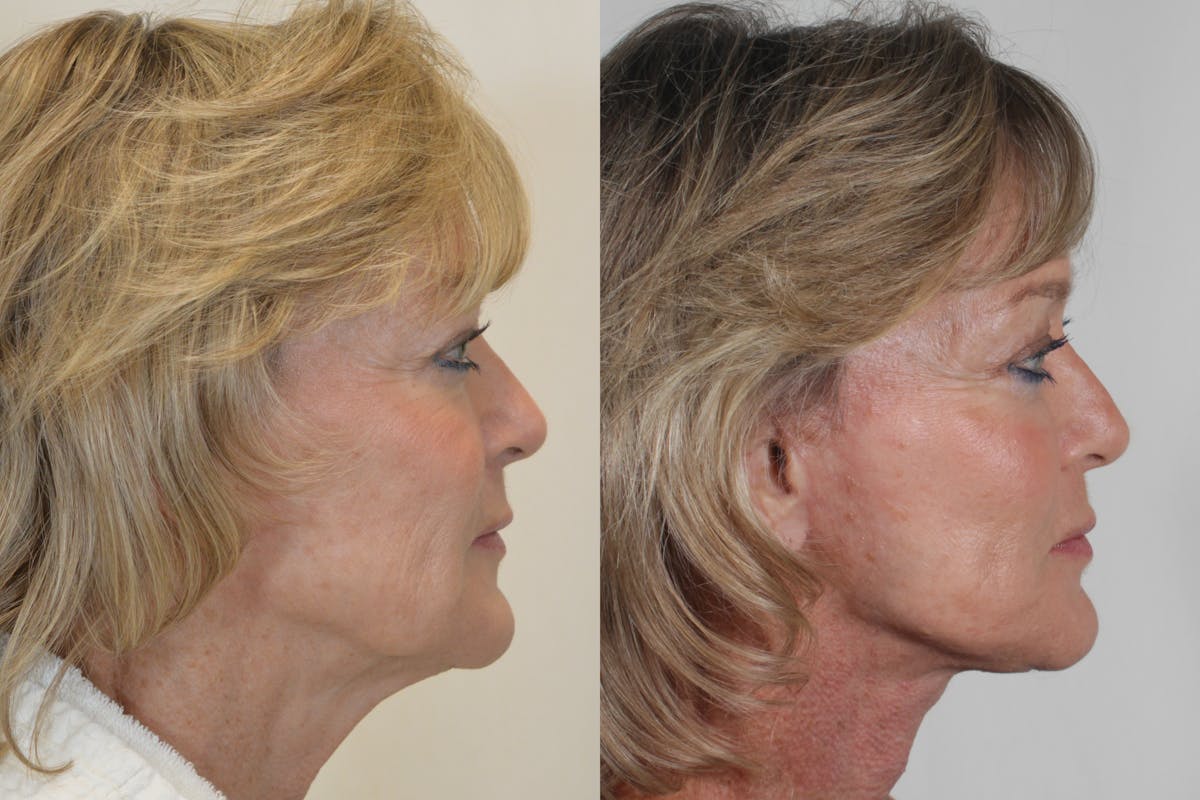 Facelift Before & After Gallery - Patient 115940 - Image 3
