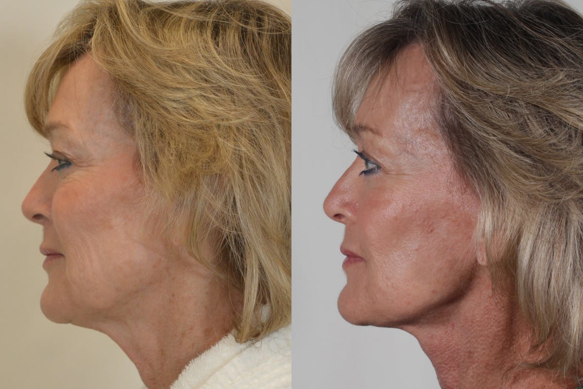 Facelift Before & After Gallery - Patient 115940 - Image 5