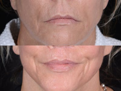 Lip Lift Before & After Gallery - Patient 372843 - Image 1