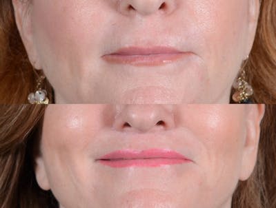 Lip Lift Before & After Gallery - Patient 112333 - Image 1