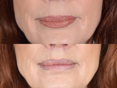 Lip Lift Before & After Gallery - Patient 222969 - Image 1