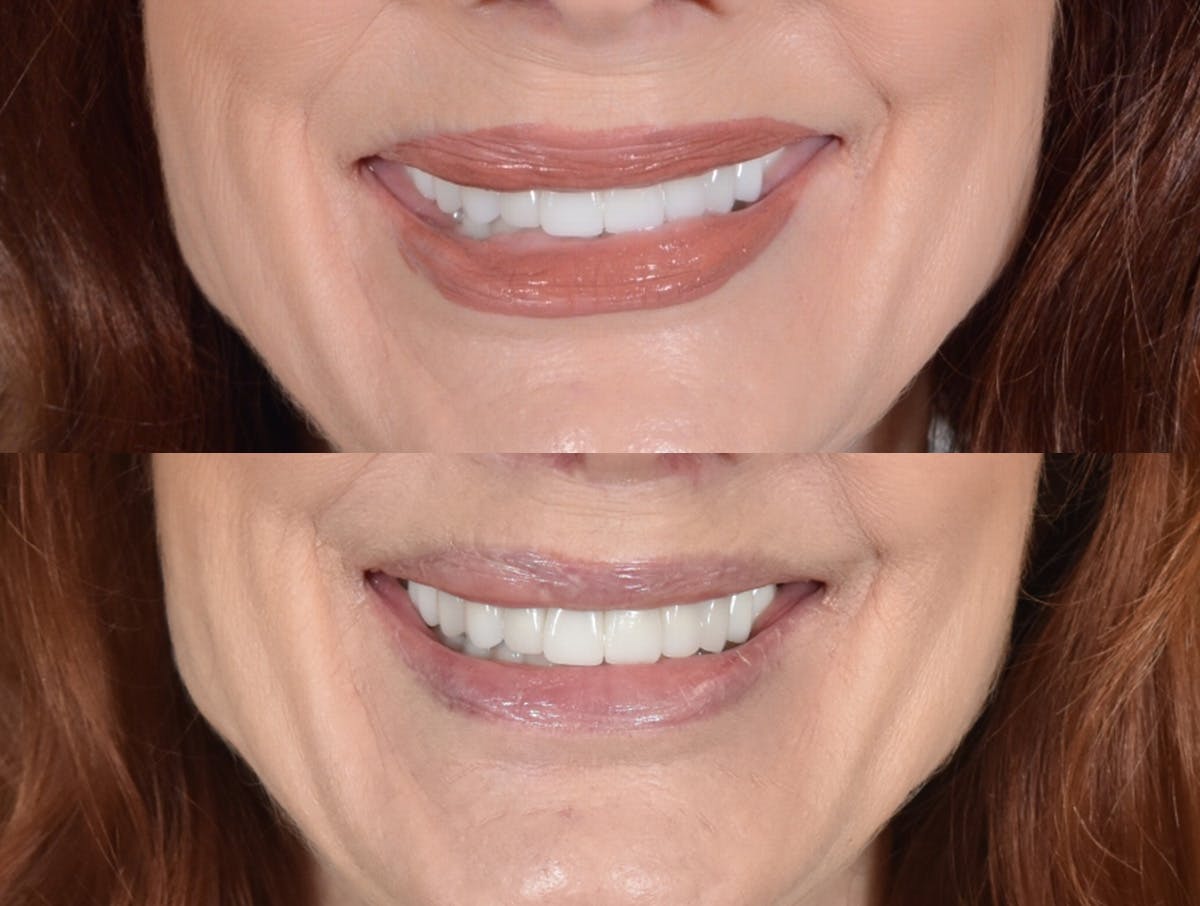 Lip Lift Before & After Gallery - Patient 222969 - Image 2