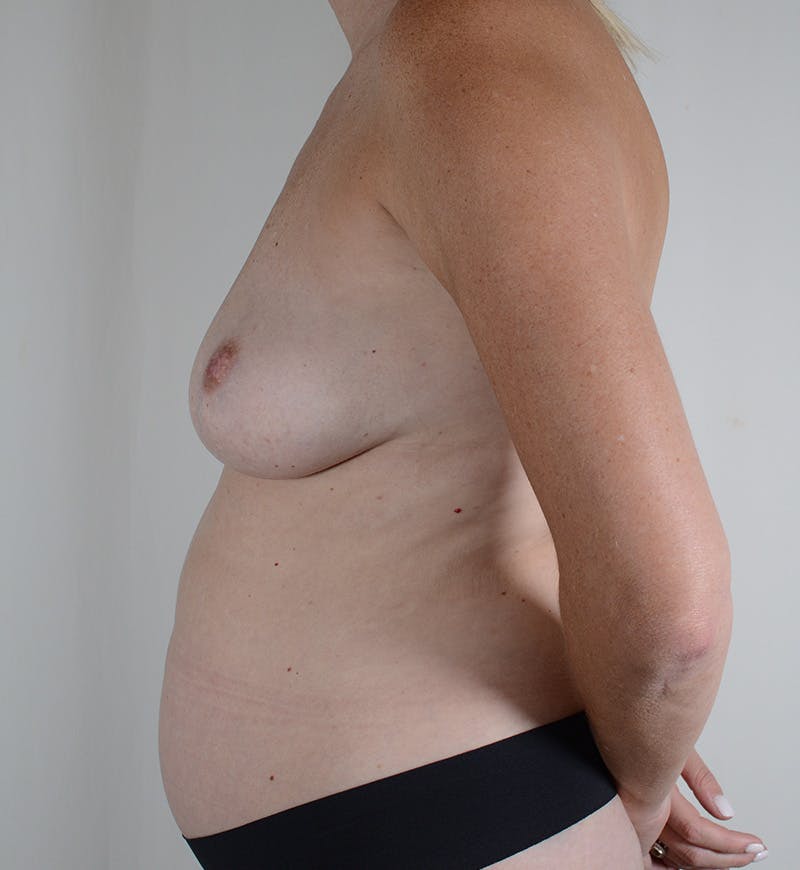 Mommy Makeover Before & After Gallery - Patient 192186 - Image 9