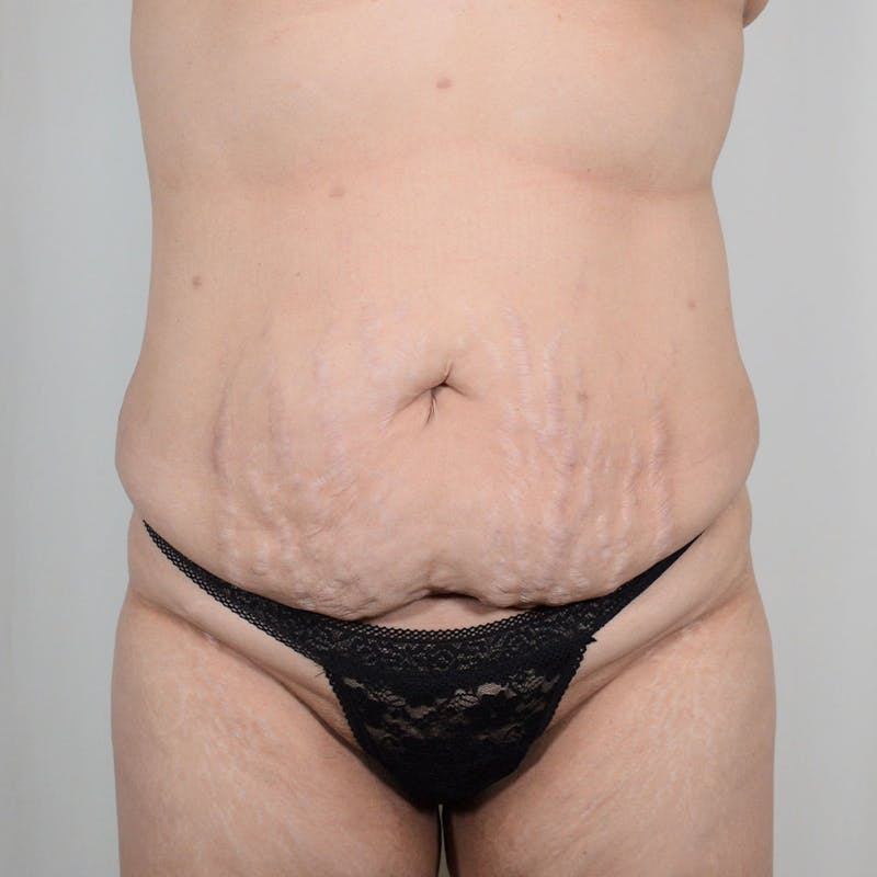 Tummy Tuck Before & After Gallery - Patient 342245 - Image 1