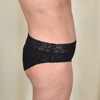 Tummy Tuck Before & After Gallery - Patient 134863 - Image 6