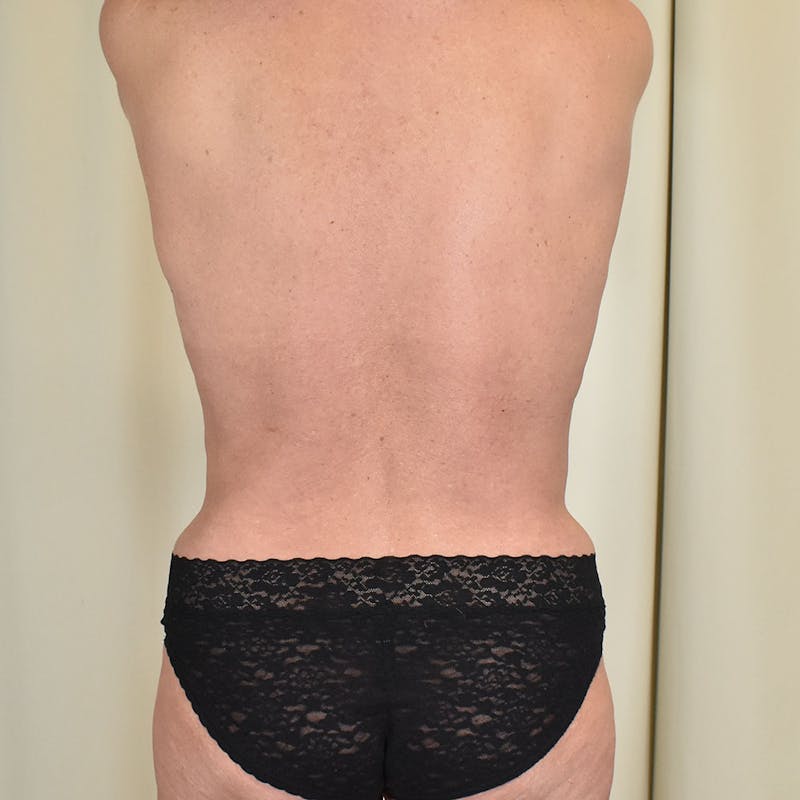 Tummy Tuck Before & After Gallery - Patient 134863 - Image 8