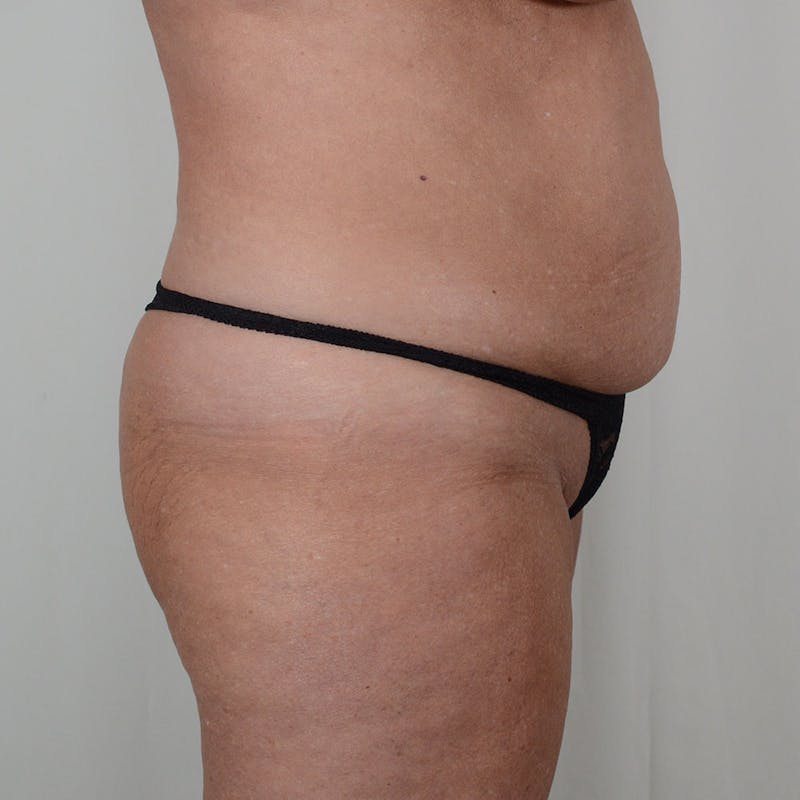Tummy Tuck Before & After Gallery - Patient 134863 - Image 5