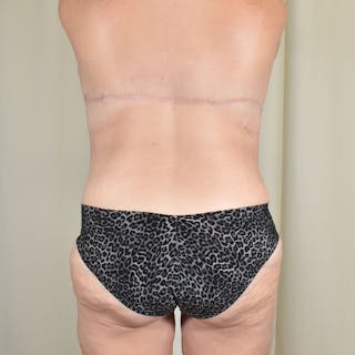 Tummy Tuck Before & After Gallery - Patient 198441 - Image 8
