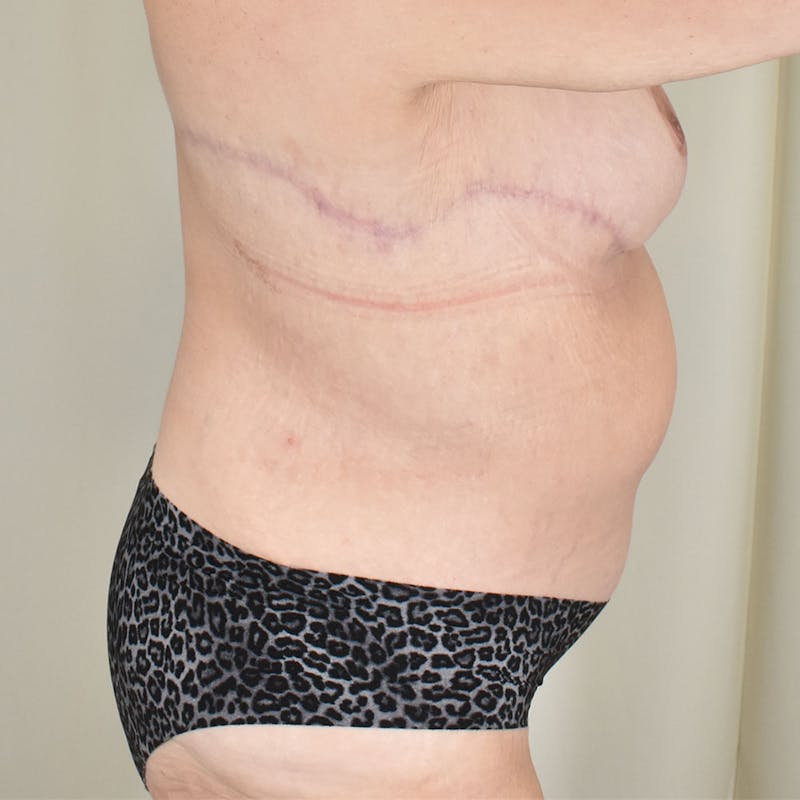 Tummy Tuck Before & After Gallery - Patient 198441 - Image 4