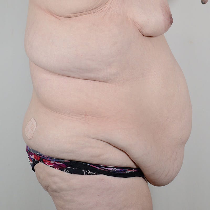 Tummy Tuck Before & After Gallery - Patient 198441 - Image 3