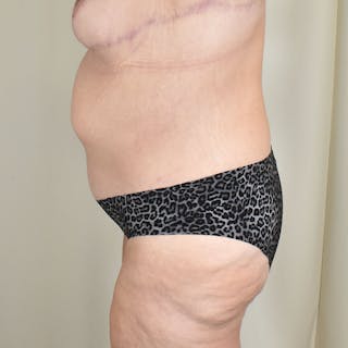 Tummy Tuck Before & After Gallery - Patient 198441 - Image 6