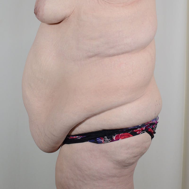 Tummy Tuck Before & After Gallery - Patient 198441 - Image 5