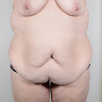 Tummy Tuck Before & After Gallery - Patient 198441 - Image 1