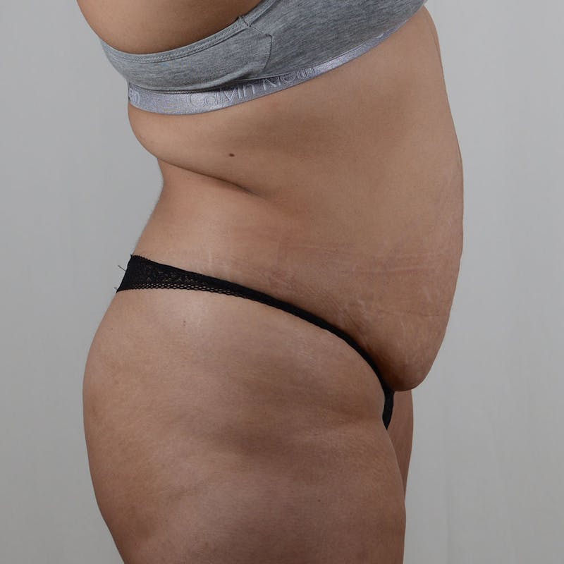 Tummy Tuck Before & After Gallery - Patient 131761 - Image 5