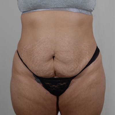 Tummy Tuck Before & After Gallery - Patient 131761 - Image 1