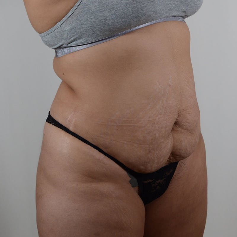 Tummy Tuck Before & After Gallery - Patient 131761 - Image 3