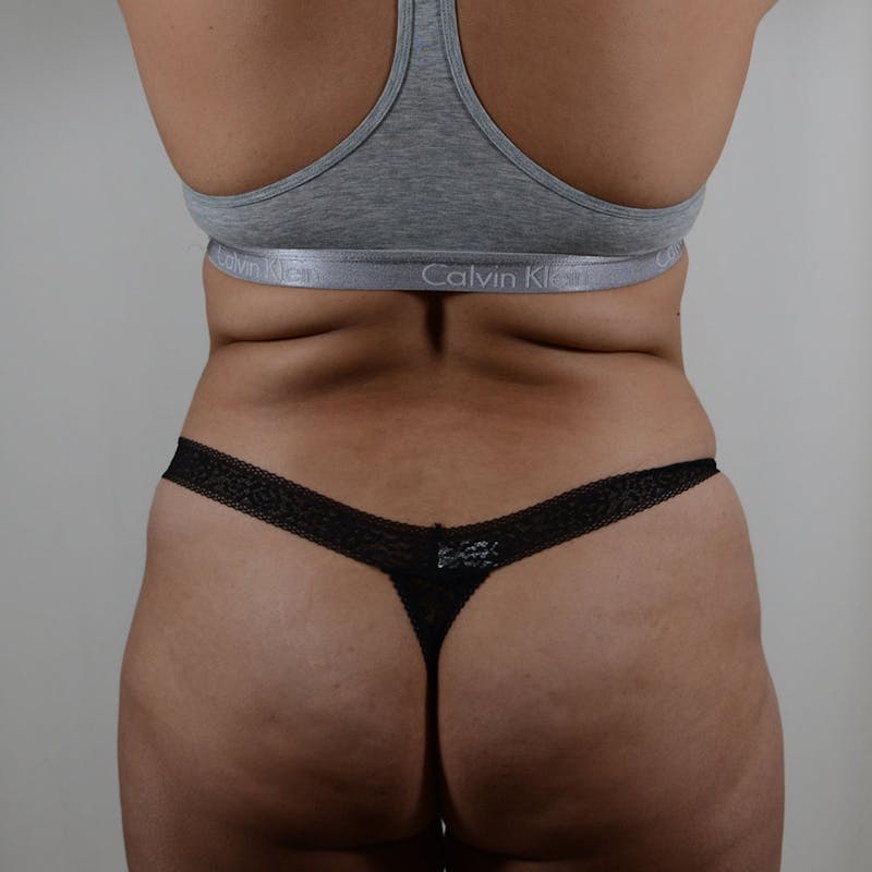 Tummy Tuck Before & After Gallery - Patient 131761 - Image 7