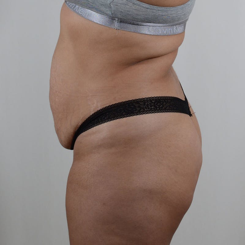 Tummy Tuck Before & After Gallery - Patient 131761 - Image 11