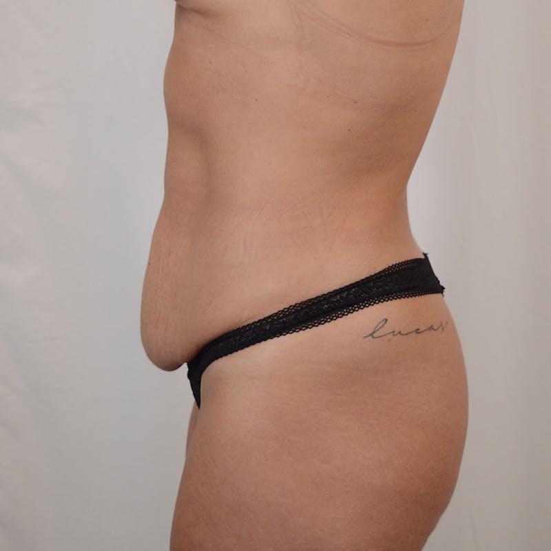 Tummy Tuck Before & After Gallery - Patient 185017 - Image 5