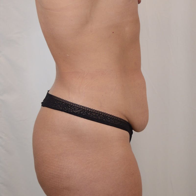 Tummy Tuck Before & After Gallery - Patient 185017 - Image 7