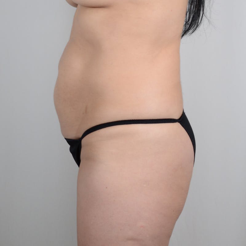 Tummy Tuck Before & After Gallery - Patient 298795 - Image 3