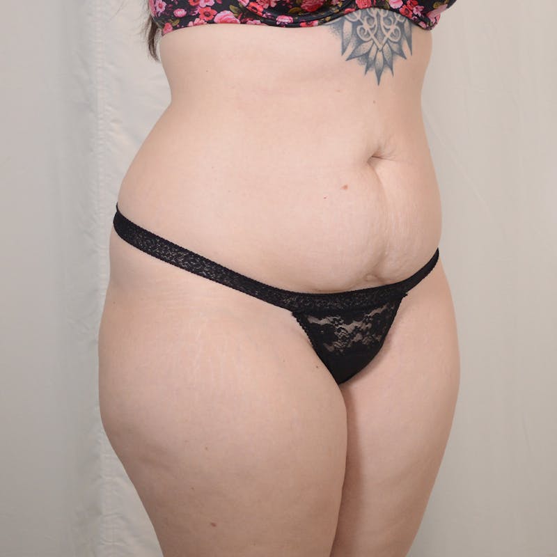 Tummy Tuck Before & After Gallery - Patient 306045 - Image 3