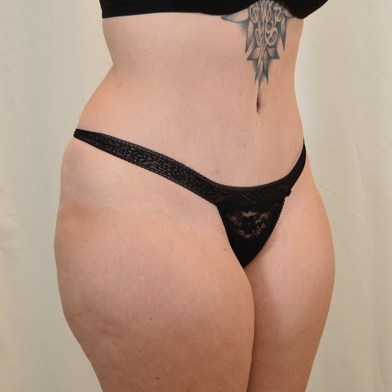 Tummy Tuck Before & After Gallery - Patient 306045 - Image 4