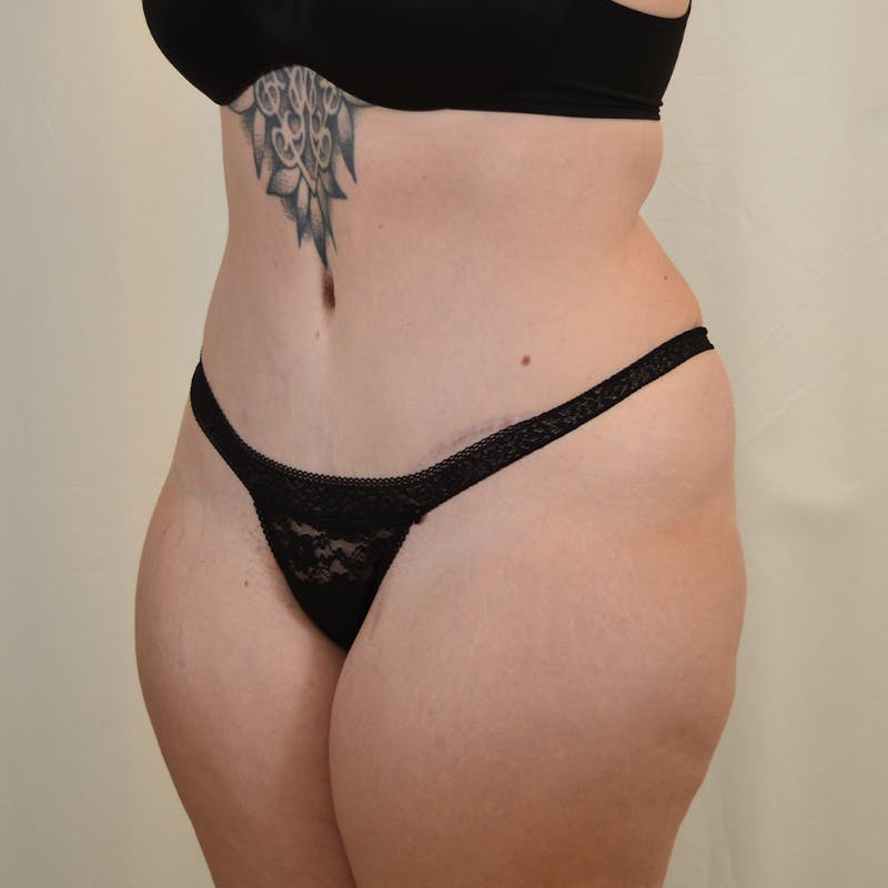 Tummy Tuck Before & After Gallery - Patient 306045 - Image 8