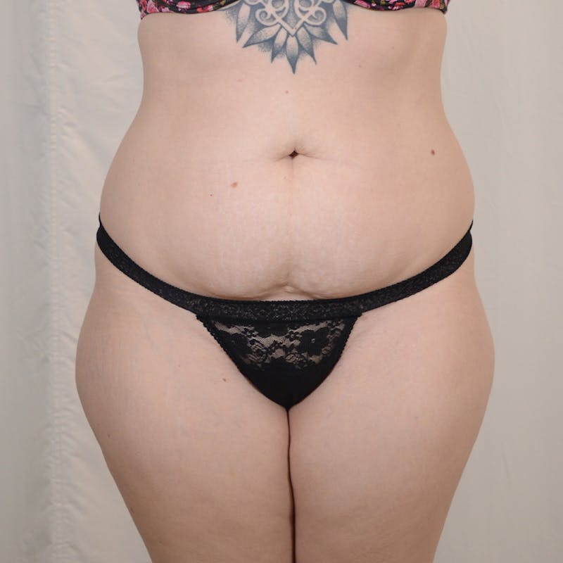 Tummy Tuck Before & After Gallery - Patient 306045 - Image 1