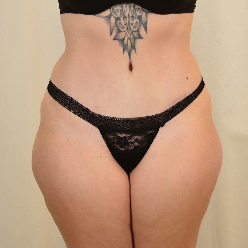 Tummy Tuck Before & After Gallery - Patient 306045 - Image 2