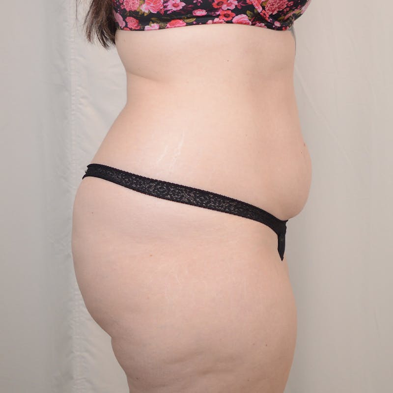 Tummy Tuck Before & After Gallery - Patient 306045 - Image 5