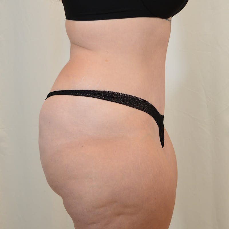 Tummy Tuck Before & After Gallery - Patient 306045 - Image 6