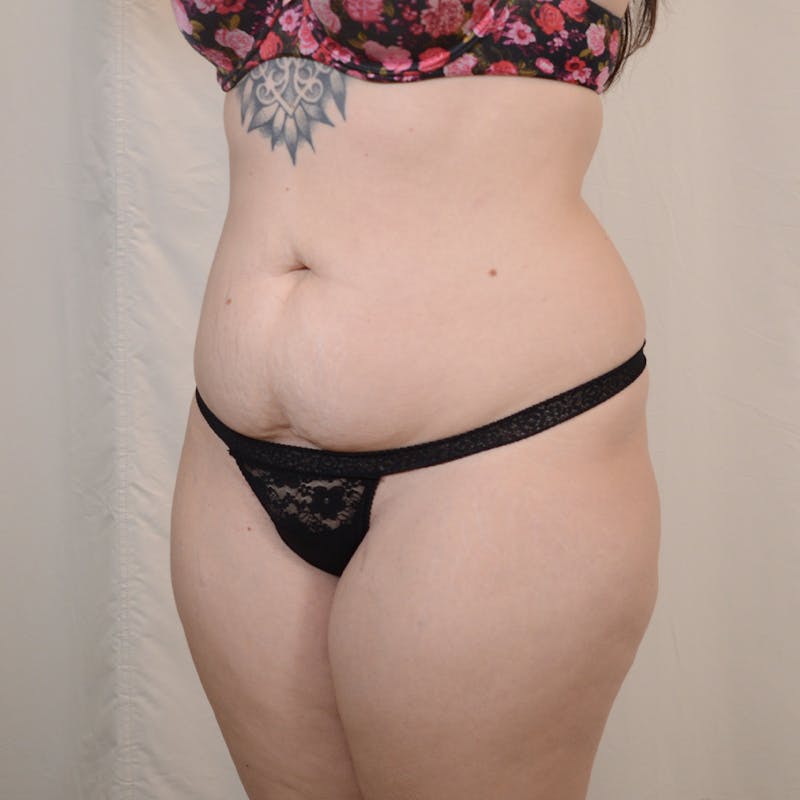 Tummy Tuck Before & After Gallery - Patient 306045 - Image 7