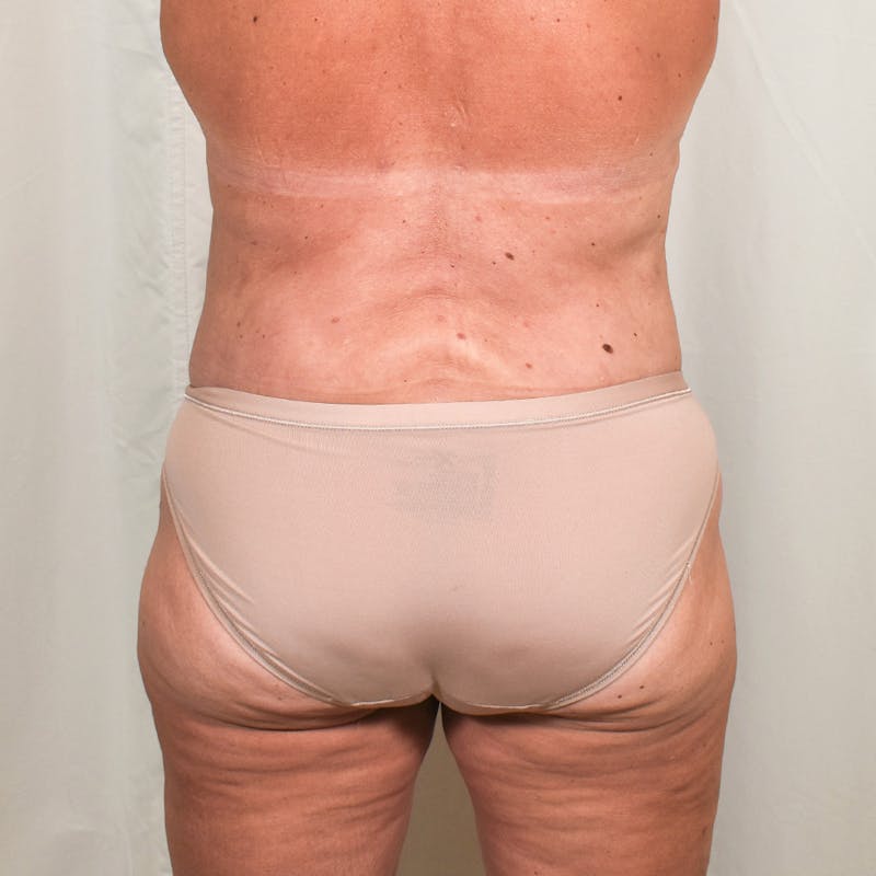Tummy Tuck Before & After Gallery - Patient 327699 - Image 8